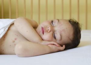 neurodermitis-baby-kind-300x214.jpg
