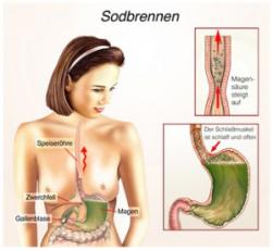 sodbrennen-in-der-schwangerschaf-300x275.jpg